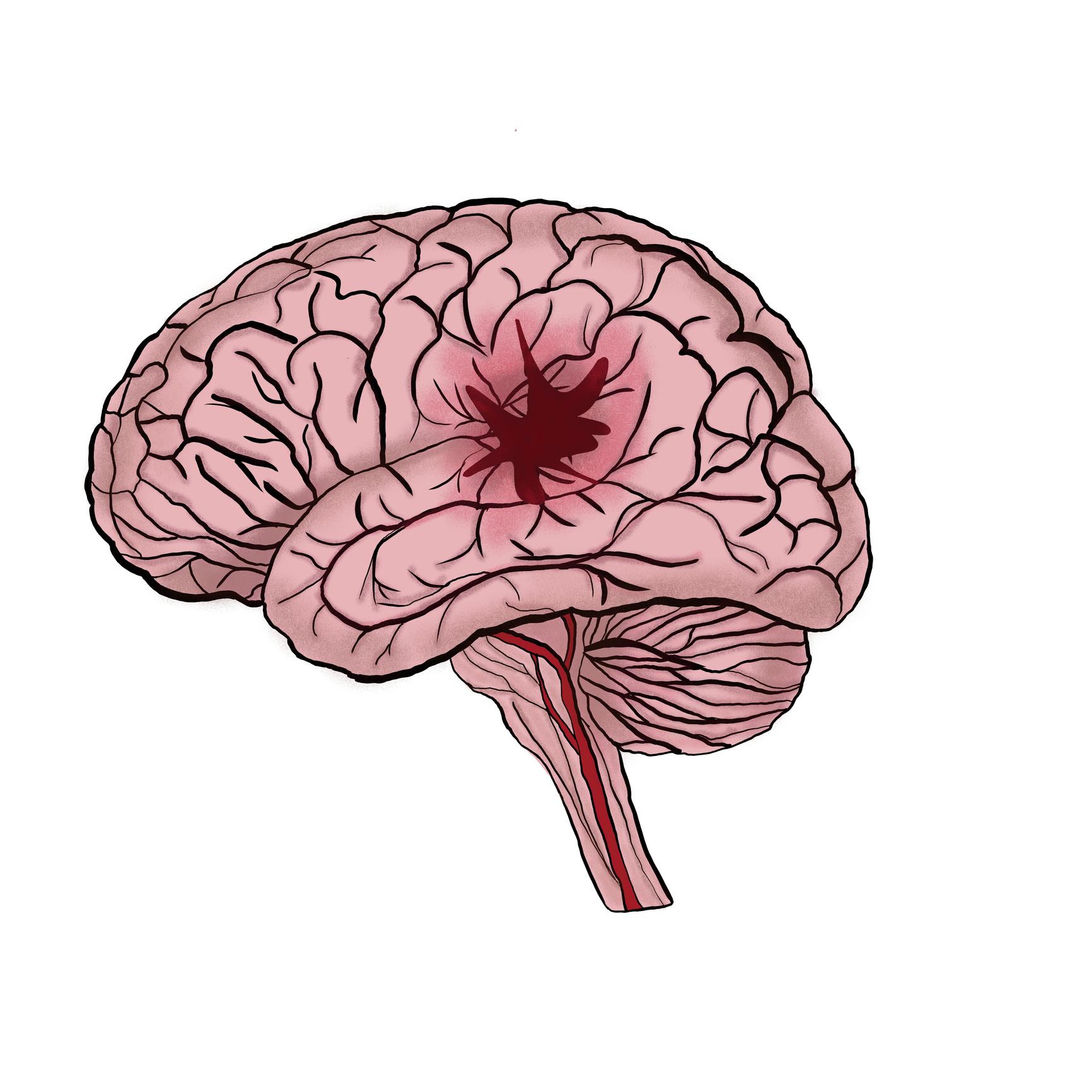 Stroke Research